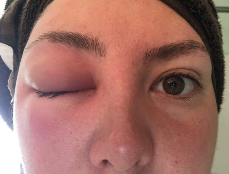 bee sting reactions 2 days later bee sting reactions 2 days later